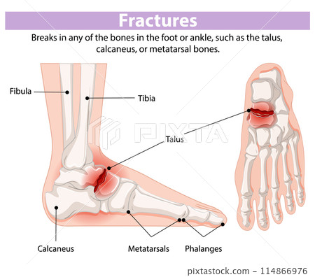 Foot and Ankle Fracture Diagram 114866976
