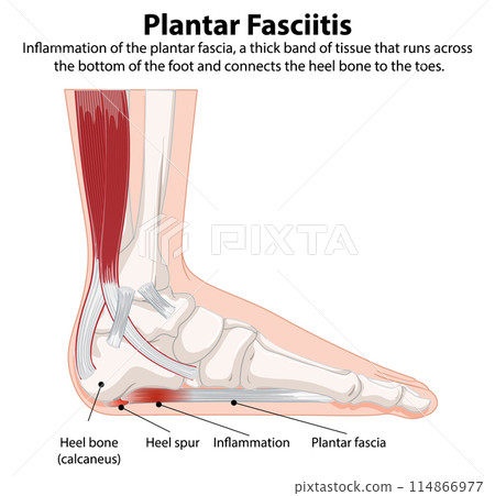 Plantar Fasciitis Medical Illustration Plantar Fasciitis Medical Illustration 114866977