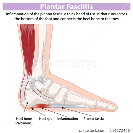 Plantar Fasciitis Medical Illustration 114872466