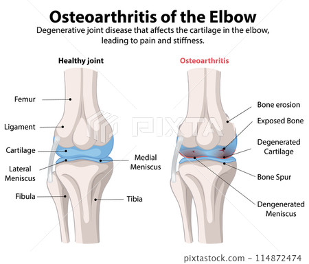 Osteoarthritis of the Elbow Osteoarthritis of the Elbow 114872474