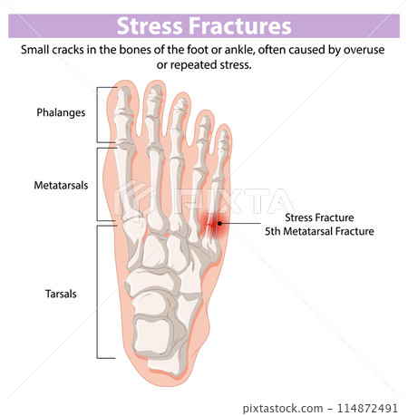 Stress Fractures in Foot Anatomy 114872491