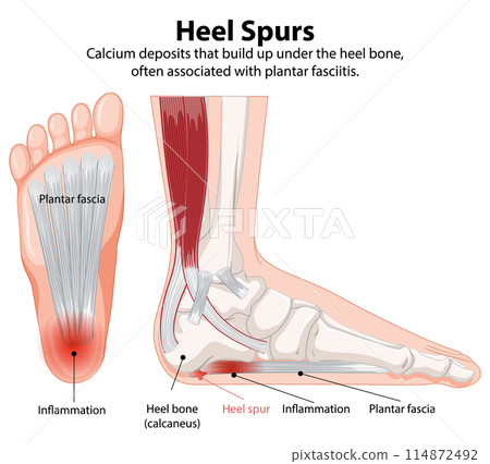 Heel Spurs and Plantar Fasciitis Heel Spurs and Plantar Fasciitis 114872492