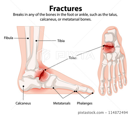 Foot and Ankle Fractures 114872494