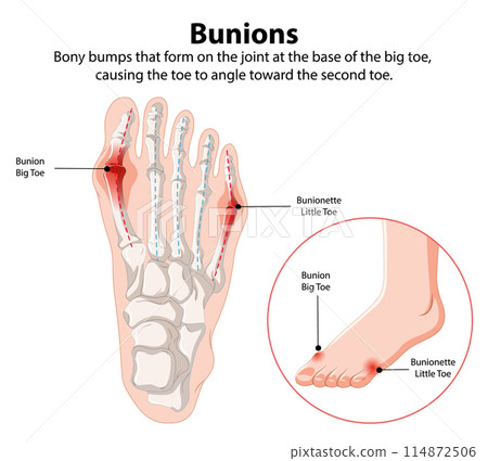 Bunions and Bunionette Illustration 114872506