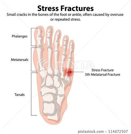 Stress Fractures in Foot Bones Stress Fractures in Foot Bones 114872507