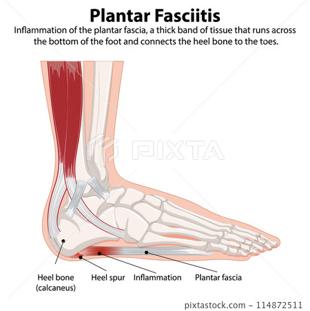 Plantar Fasciitis Foot Anatomy Illustration Plantar Fasciitis Foot Anatomy Illustration 114872511