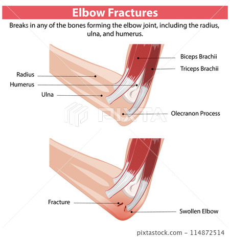 Elbow Fractures Illustration Elbow Fractures Illustration 114872514