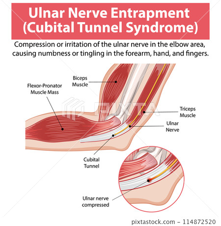 Ulnar Nerve Entrapment Illustration 114872520