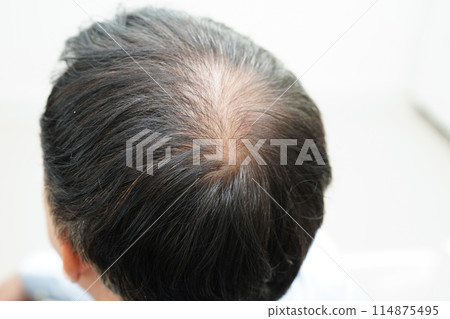 Bald head in man, hair loss treatment health problem. Bald head in man, hair loss treatment health problem. 114875495