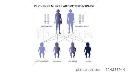 Duchenne muscular dystrophy Duchenne muscular dystrophy 114883944