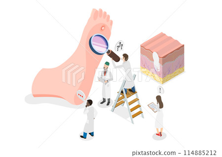 3D Isometric Flat  Conceptual Illustration of Foot Wart, Swollen Skin with Rough, Yellowing Patch 114885212