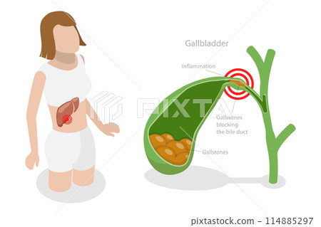 3D Isometric Flat  Conceptual Illustration of Gallstone Disease, Formations in the Gallbladder 114885297