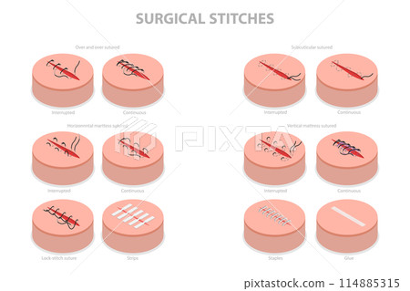 3D Isometric Flat Conceptual Illustration of Surgical Stitches, Medical Suture 3D Isometric Flat Conceptual Illustration of Surgical Stitches, Medical Suture 114885315