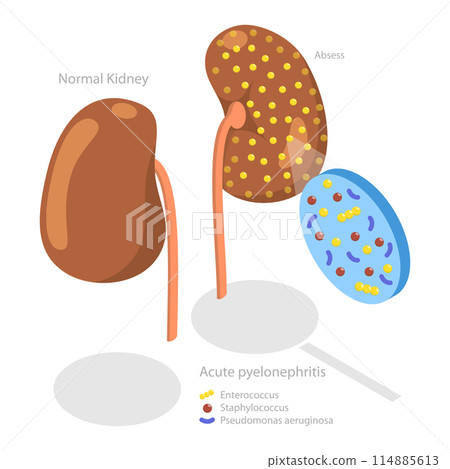 3D Isometric Flat Conceptual Illustration of Acute Pyelonephritis, Urinary Tract Infection 3D Isometric Flat Conceptual Illustration of Acute Pyelonephritis, Urinary Tract Infection 114885613