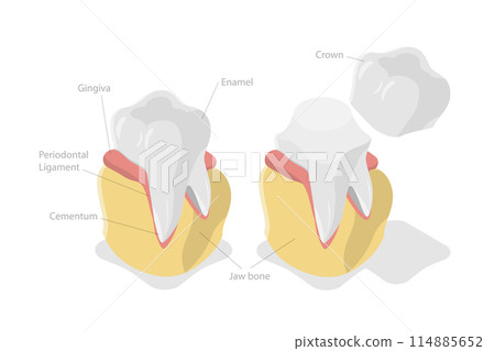 3D Isometric Flat  Conceptual Illustration of Dental Crown Restoration, Tooth Prosthesis 114885652