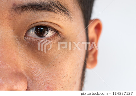 Close up of unhealthy Asian man having under-eye problem such as dark circles and puffiness. Using a collagen hydro gel under-eye mask can allow the skin to be soaked in moisture. 114887127