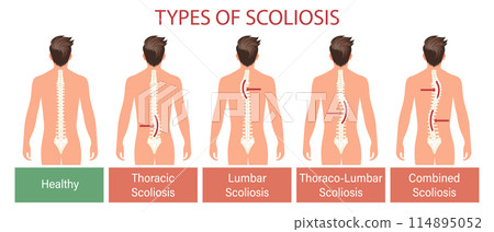 Types of scoliosis, spinal disease. Infographics banner with human scoliosis spine. Healthcare and medicine. Illustration, poster Types of scoliosis, spinal disease. Infographics banner with human scoliosis spine. Healthcare and medicine. Illustration, poster 114895052
