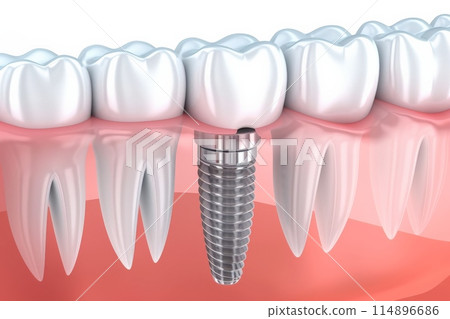 The concept of dental implants. A 3D rendering showing a dental implant placed between teeth The concept of dental implants. A 3D rendering showing a dental implant placed between teeth 114896686