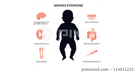 Menkes syndrome poster 114911222