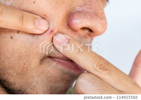 Close up of young man squeezing pimple or acne on his skin. A pimple is a small inflammation or swelling of the skin that may or may not be filled with pus. Close up of young man squeezing pimple or acne on his skin. A pimple is a small inflammation or swelling of the skin that may or may not be filled with pus. 114915592