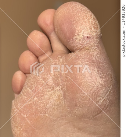 A lot of small cracks and dry flaky skin on the foot. The concept of foot care, pedicure A lot of small cracks and dry flaky skin on the foot. The concept of foot care, pedicure 114933926