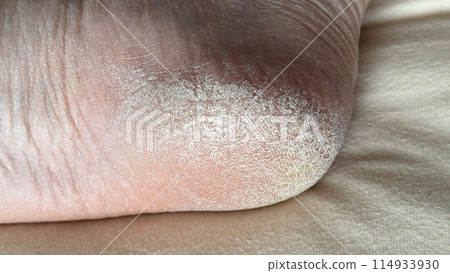 Close-up of the crack on the heel. Small cracks and dry flaky skin on the foot. The concept of foot care, pedicure Close-up of the crack on the heel. Small cracks and dry flaky skin on the foot. The concept of foot care, pedicure 114933930