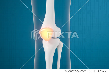 Leg bone and knee lesions, 3d rendering. Leg bone and knee lesions, 3d rendering. 114947677