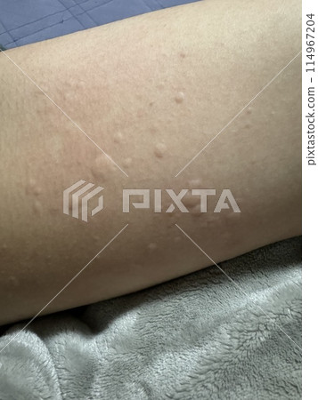 Urticaria Urticaria 114967204