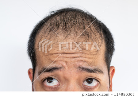 Cropped shot view of Asian man worry about his hair loss and baldness problem. Conceptual of hair problem on men's head. 114980305
