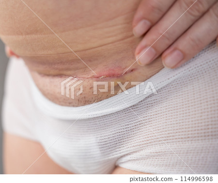 A woman shows off a fresh scar from a caesarean section. A woman shows off a fresh scar from a caesarean section. 114996598