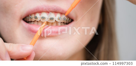 Unrecognizable Caucasian woman cleans braces with a brush. Close-up of female teeth with brackets Unrecognizable Caucasian woman cleans braces with a brush. Close-up of female teeth with brackets 114997303