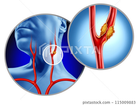 Carotid Artery Disease Carotid Artery Disease 115009883