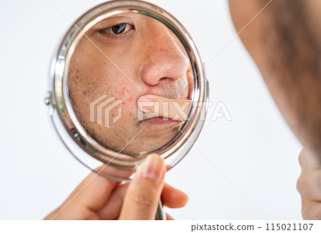 Cropped shot of Asian man saw the problem of pimple or acne on his face by a mini mirror. Conceptual shot of Acne and problem skin on male face. 115021107