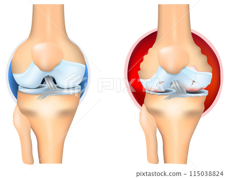 Rheumatoid Arthritis of knee joint 115038824