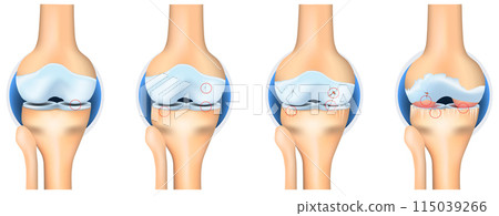 Stages of Osteoarthritis. knee joint anatomy 115039266