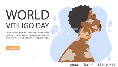 Afro-american woman illustration with vitiligo banner. World Vitiligo Day. 115050714