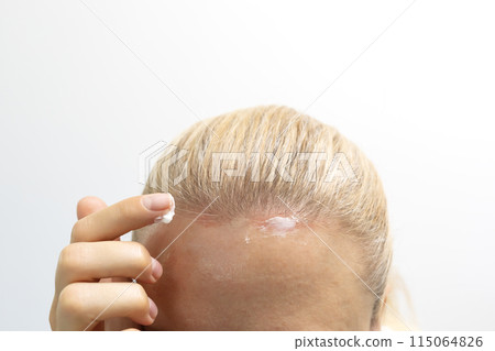 Cropped Female Applies Moisturizer, Cream on Sunburn Skin On Scalp, Forehead Under Hair. White Background. Solar Erythema. White Woman Suffers From Sun Burn. Horizontal. Ultraviolet Danger 115064826