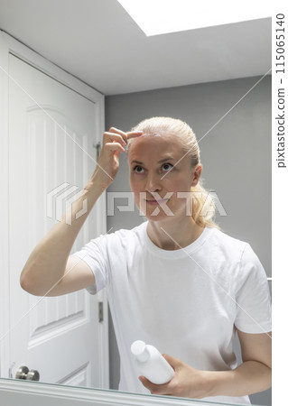 Caucasian Female Applies Moisturizer, Cream on Sunburn Skin On Scalp, Forehead Under Hair in Bathroom. White Woman Suffers From Face Sun Burn, Holding White Tube, Bottle of Remedy. UV Danger. Vertical 115065140