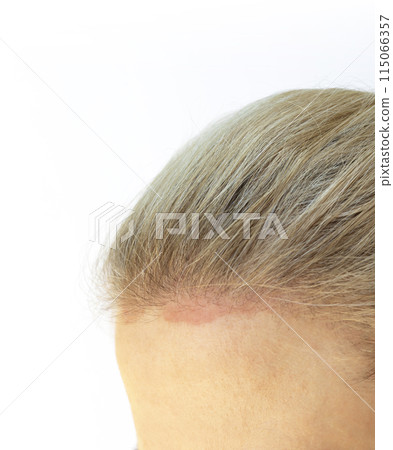 Closeup Cropped Caucasian Female Face with Sunburn Skin On Scalp, Forehead Under Hair, White Background. White Woman Suffers From Face Sun Burn. UV Danger. Copy Space 115066357