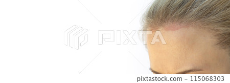 Banner Cropped Caucasian Female Face with Sunburn Skin On Scalp, Forehead Under Hair, White Background, Copy Space. White Woman Suffers From Face Sun Burn. UV Danger. Horizontal Plane 115068303