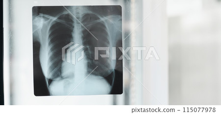 A close up of a chest x-ray of a person's lungs. The image is in black and white and the lungs are clearly visible A close up of a chest x-ray of a person's lungs. The image is in black and white and the lungs are clearly visible 115077978