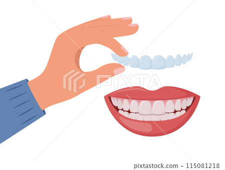 Hand applying clear aligner on teeth. Concepts of dental care and orthodontic dentistry. Teeth straightening with clear aligners. Vector. 115081218