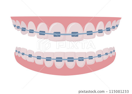 Upper and lower jaws with braces on teeth. Orthodontics and aesthetic dentistry medicine. Healthy smile. Dentistry, whitening, orthodontics. Vector. 115081233