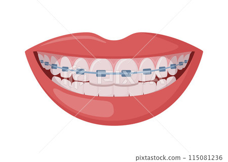 Braces Corrective Orthodontics, smiling female mouth with healthy teeth and braces. Dentistry, dental treatment, orthodontics. Vector. Braces Corrective Orthodontics, smiling female mouth with healthy teeth and braces. Dentistry, dental treatment, orthodontics. Vector. 115081236