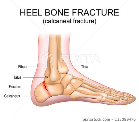 Heel bone fracture. Calcaneal fracture 115089476