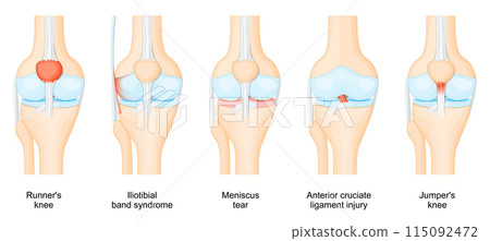 Knee injuries. Anatomy of human knee. 115092472