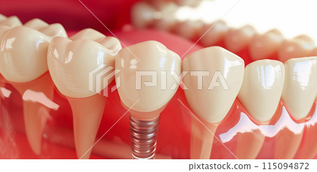 Close up of dental teeth implant. 115094872