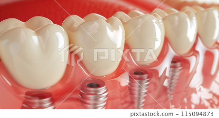 Close up of dental teeth implant. 115094873