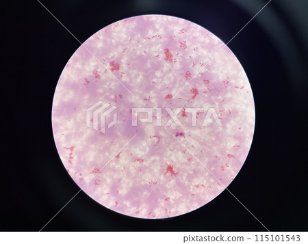 Moderate gram negtive bacilli in hemoculture. Moderate gram negtive bacilli in hemoculture. 115101543