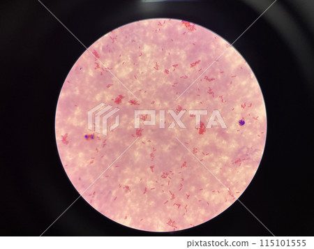 Moderate gram negtive bacilli in hemoculture. Moderate gram negtive bacilli in hemoculture. 115101555